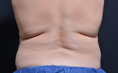 CoolSculpting Before & After Gallery - Patient 231639 - Image 1