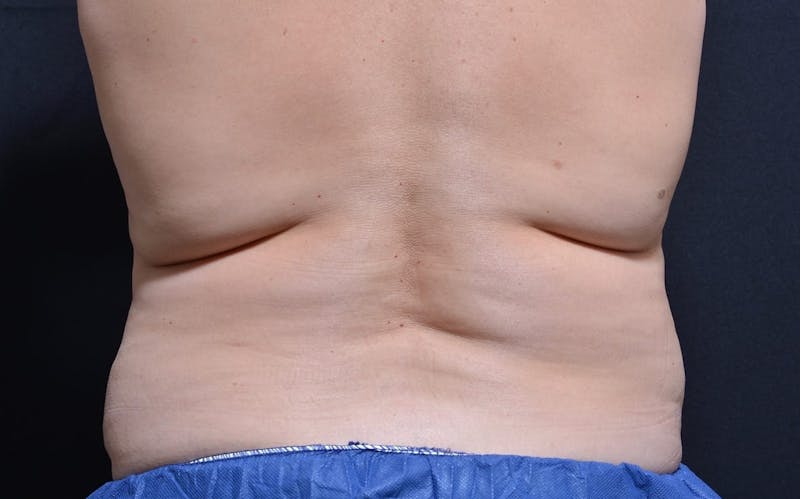 CoolSculpting Before & After Gallery - Patient 231639 - Image 1