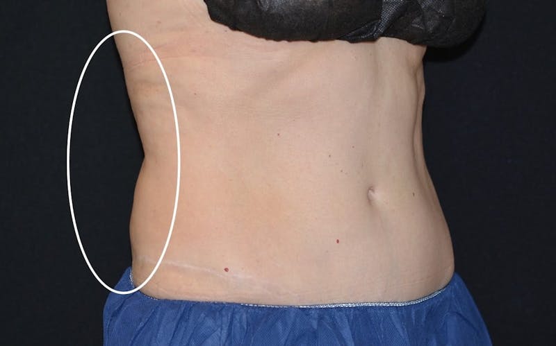 CoolSculpting Before & After Gallery - Patient 311798 - Image 2