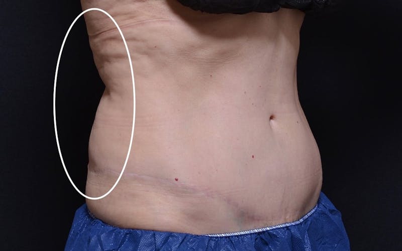 CoolSculpting Before & After Gallery - Patient 311798 - Image 1
