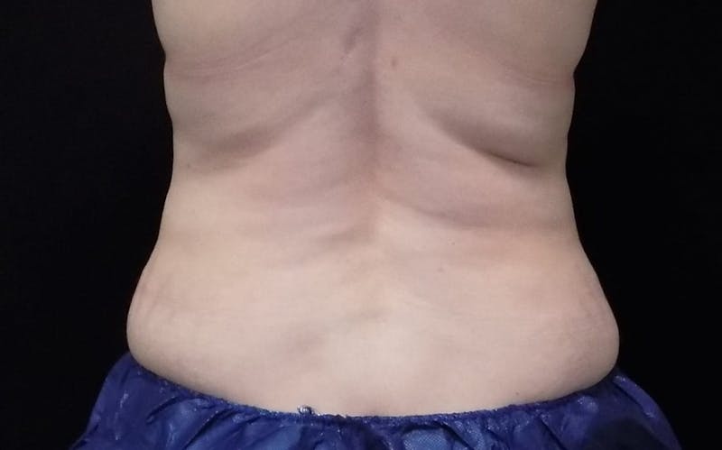 CoolSculpting Before & After Gallery - Patient 861072 - Image 1
