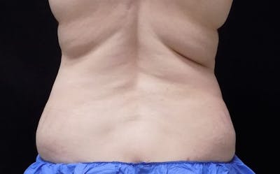 CoolSculpting Before & After Gallery - Patient 861072 - Image 2