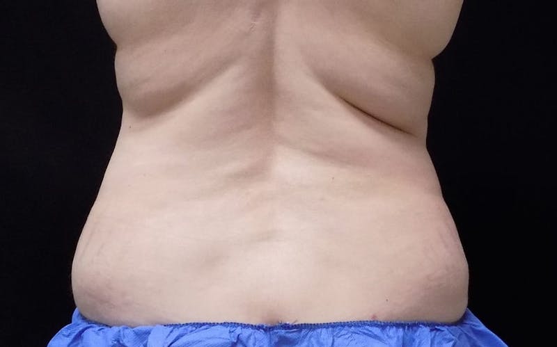 CoolSculpting Before & After Gallery - Patient 861072 - Image 2