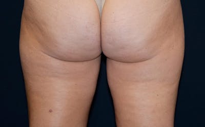 CoolSculpting Before & After Gallery - Patient 271412 - Image 2