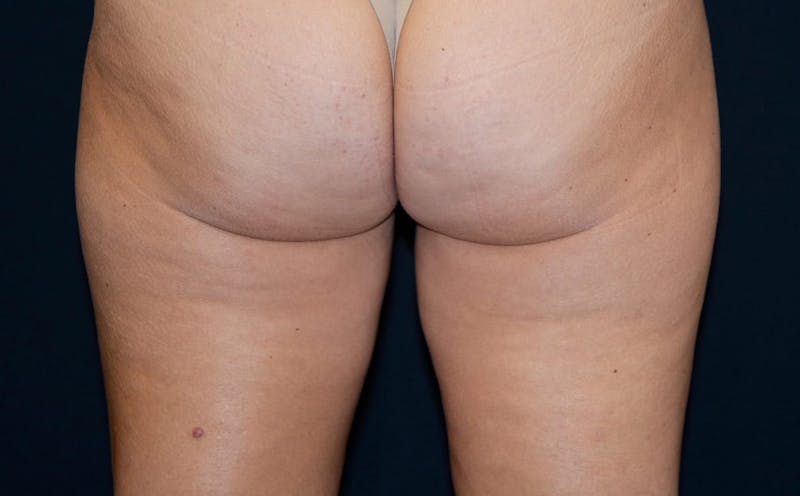 CoolSculpting Before & After Gallery - Patient 271412 - Image 2