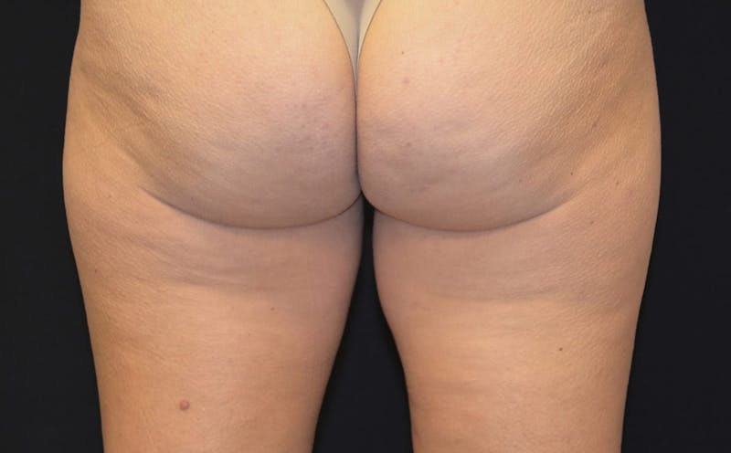 CoolSculpting Before & After Gallery - Patient 271412 - Image 1