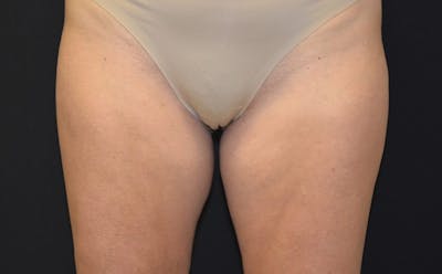 CoolSculpting Before & After Gallery - Patient 168840 - Image 1