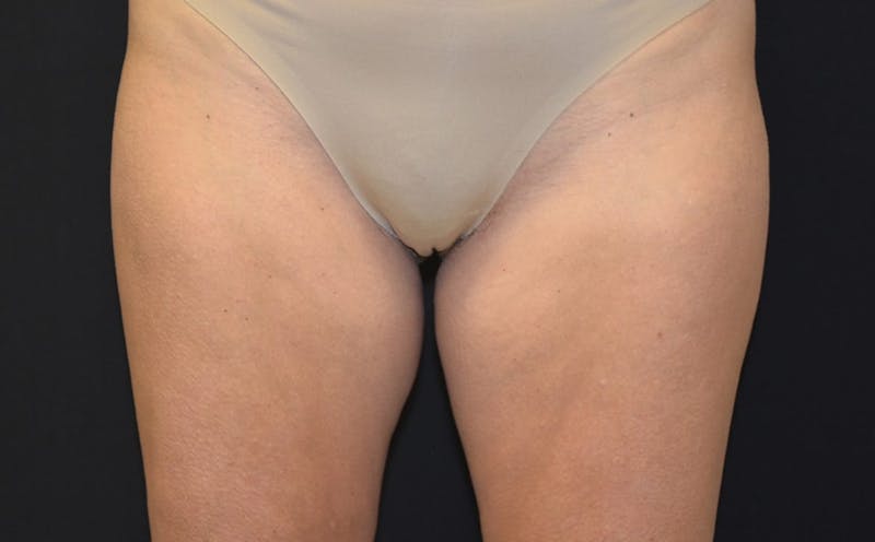 CoolSculpting Before & After Gallery - Patient 168840 - Image 1
