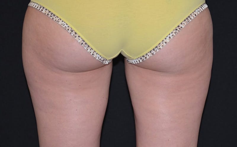 CoolSculpting Before & After Gallery - Patient 125152 - Image 2