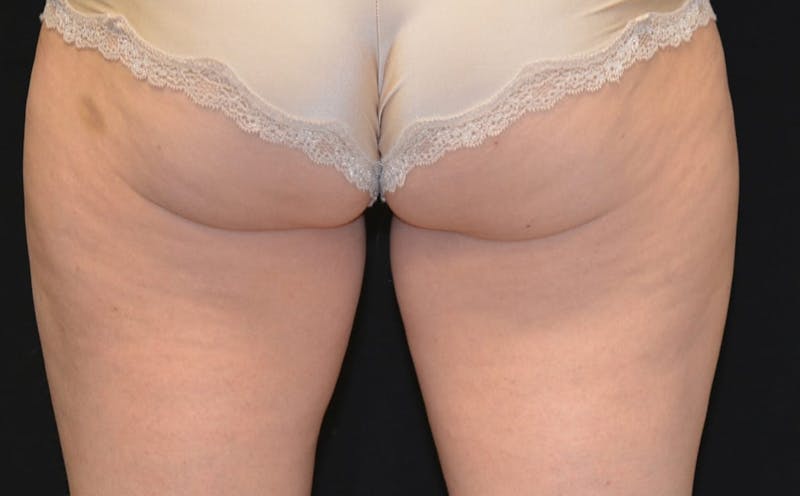 CoolSculpting Before & After Gallery - Patient 884931 - Image 1