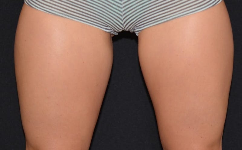 CoolSculpting Before & After Gallery - Patient 113729 - Image 2