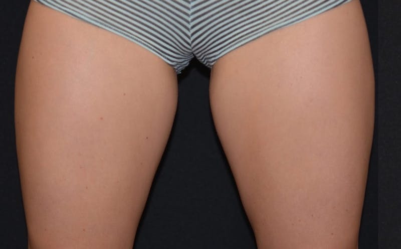 CoolSculpting Before & After Gallery - Patient 113729 - Image 1