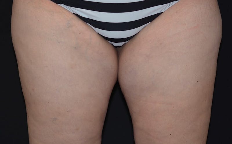 CoolSculpting Before & After Gallery - Patient 222404 - Image 1