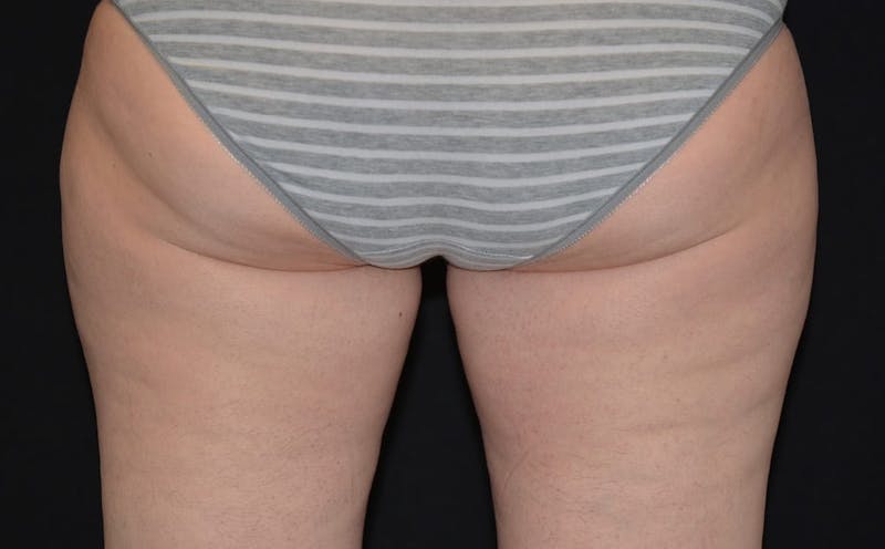 CoolSculpting Before & After Gallery - Patient 170101 - Image 2