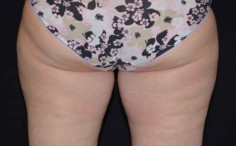 CoolSculpting Before & After Gallery - Patient 170101 - Image 1