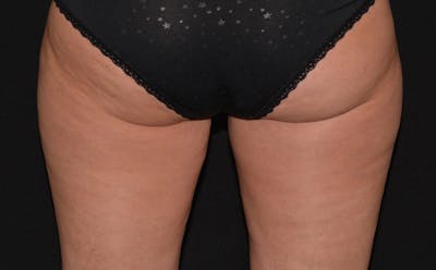 CoolSculpting Before & After Gallery - Patient 222983 - Image 2