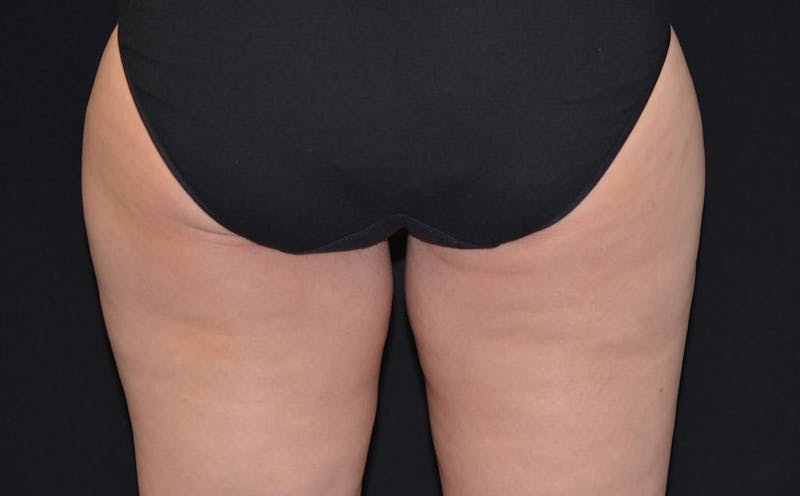 CoolSculpting Before & After Gallery - Patient 139515 - Image 2