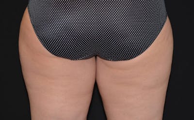 CoolSculpting Before & After Gallery - Patient 139515 - Image 1