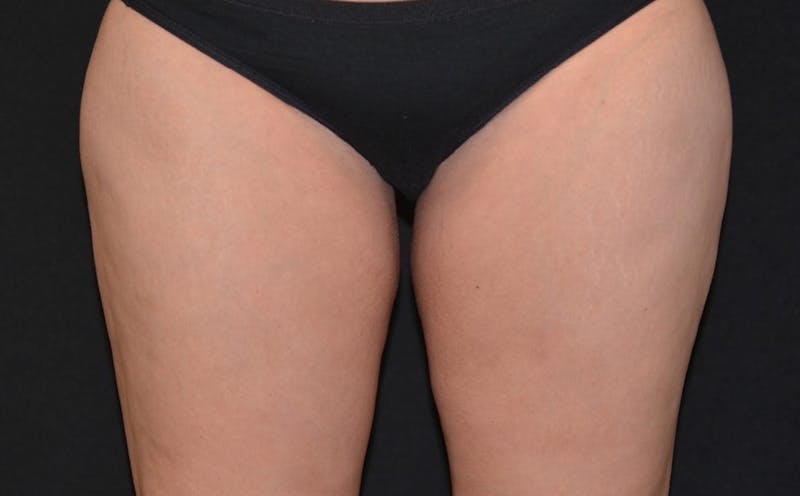 CoolSculpting Before & After Gallery - Patient 139515 - Image 4