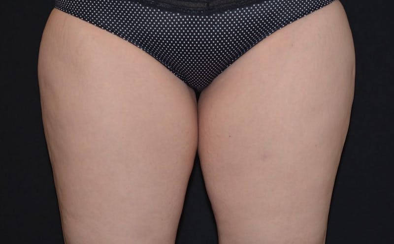CoolSculpting Before & After Gallery - Patient 139515 - Image 3