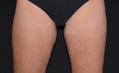 CoolSculpting Before & After Gallery - Patient 559831 - Image 2