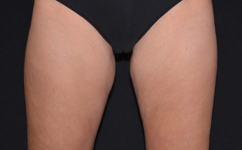CoolSculpting Before & After Gallery - Patient 559831 - Image 2