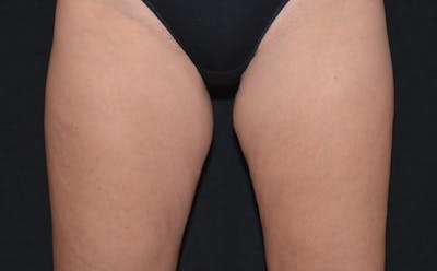 CoolSculpting Before & After Gallery - Patient 559831 - Image 1