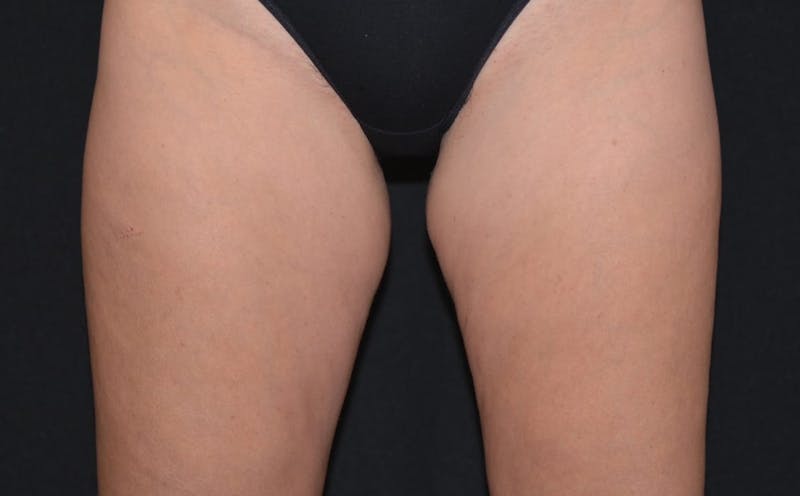 CoolSculpting Before & After Gallery - Patient 559831 - Image 1
