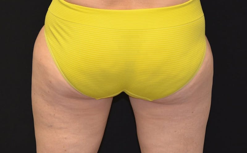 CoolSculpting Before & After Gallery - Patient 179629 - Image 2
