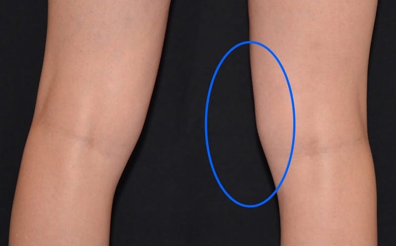 CoolSculpting Before & After Gallery - Patient 402096 - Image 2