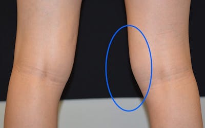 CoolSculpting Before & After Gallery - Patient 402096 - Image 1