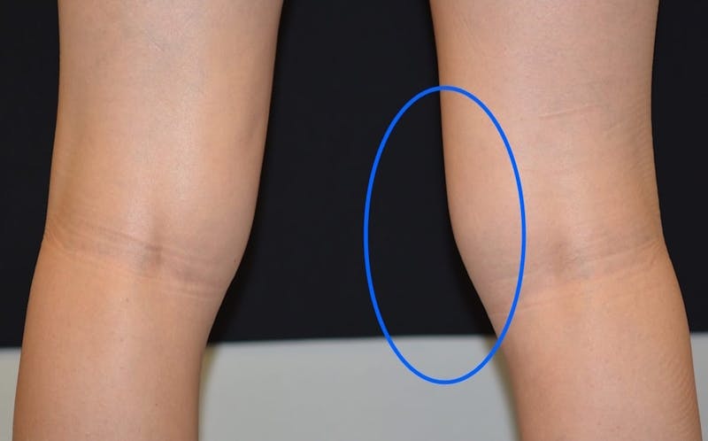 CoolSculpting Before & After Gallery - Patient 402096 - Image 1