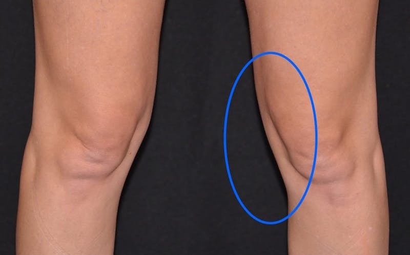 CoolSculpting Before & After Gallery - Patient 402096 - Image 4