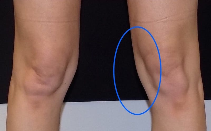 CoolSculpting Before & After Gallery - Patient 402096 - Image 3