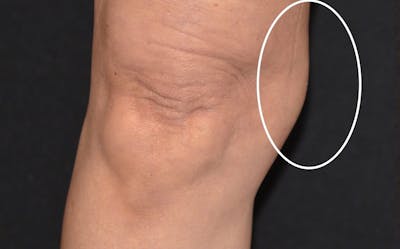 CoolSculpting Before & After Gallery - Patient 382587 - Image 2
