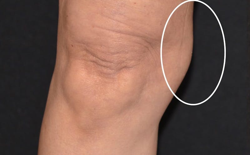 CoolSculpting Before & After Gallery - Patient 382587 - Image 2