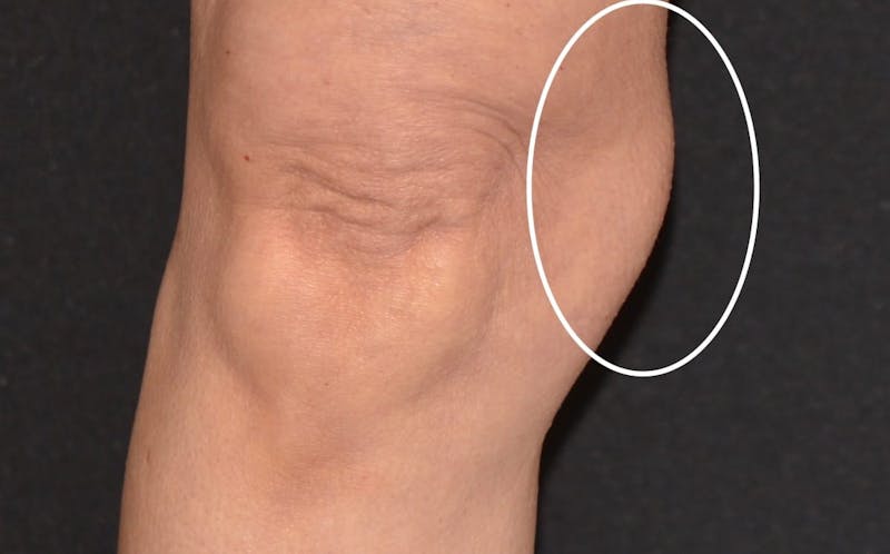 CoolSculpting Before & After Gallery - Patient 382587 - Image 1