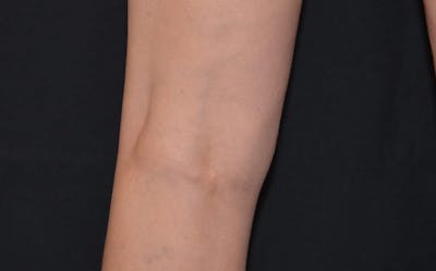 CoolSculpting Before & After Gallery - Patient 161409 - Image 2