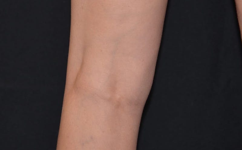 CoolSculpting Before & After Gallery - Patient 161409 - Image 2