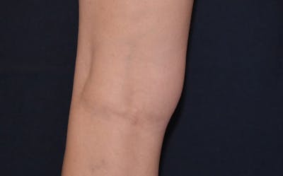 CoolSculpting Before & After Gallery - Patient 161409 - Image 1