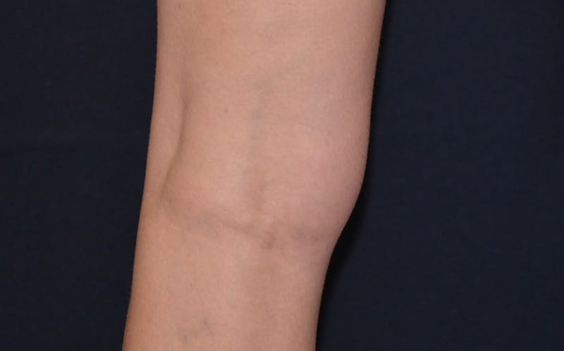 CoolSculpting Before & After Gallery - Patient 161409 - Image 1