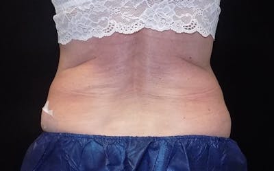 CoolSculpting Before & After Gallery - Patient 275352 - Image 2