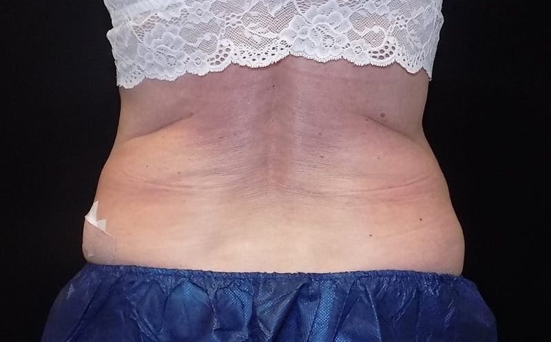 CoolSculpting Before & After Gallery - Patient 275352 - Image 2