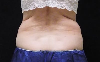 CoolSculpting Before & After Gallery - Patient 275352 - Image 1