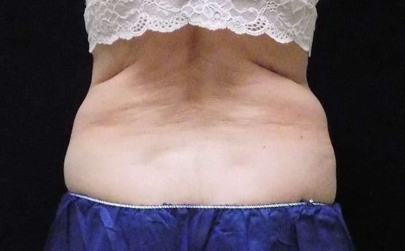 CoolSculpting Before & After Gallery - Patient 275352 - Image 1