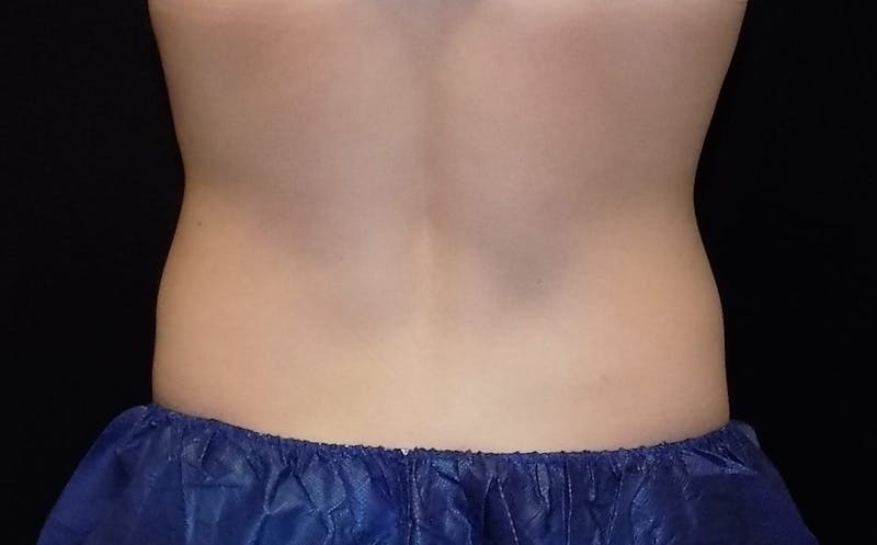CoolSculpting Before & After Gallery - Patient 210148 - Image 2