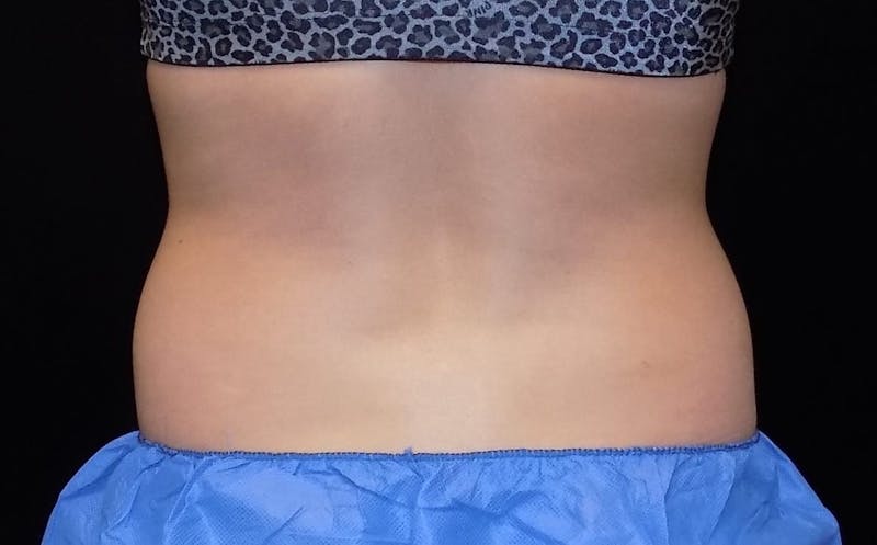 CoolSculpting Before & After Gallery - Patient 210148 - Image 1