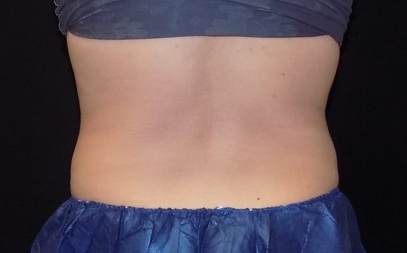 CoolSculpting Before & After Gallery - Patient 283985 - Image 2