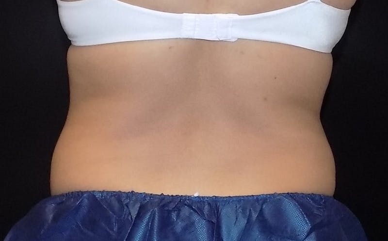 CoolSculpting Before & After Gallery - Patient 283985 - Image 1