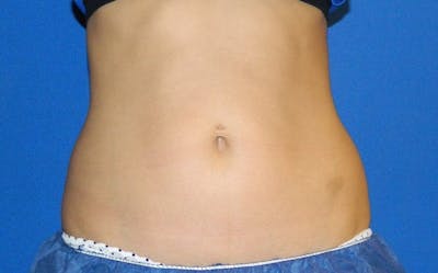 CoolSculpting Before & After Gallery - Patient 178176 - Image 2